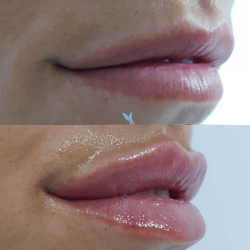 Aumento de labios